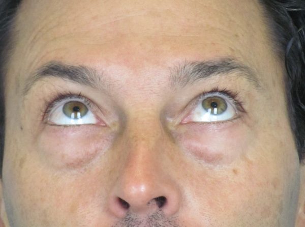 Lowcountry Lid Lift Blepharoplasty Before and After | Thomas Funcik MD