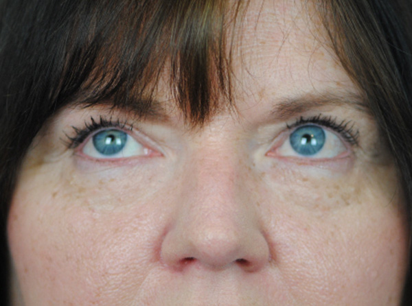 Lowcountry Lid Lift Blepharoplasty Before and After | Thomas Funcik MD