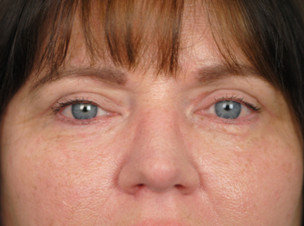 Lowcountry Lid Lift Blepharoplasty Before and After | Thomas Funcik MD