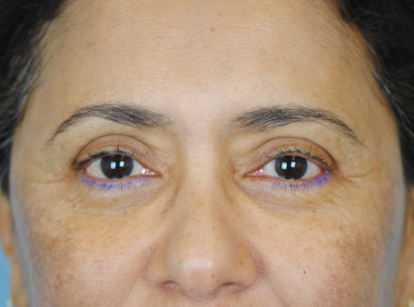 Lowcountry Lid Lift Blepharoplasty Before and After | Thomas Funcik MD