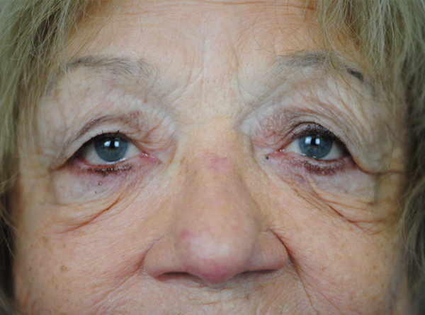 Lowcountry Lid Lift Blepharoplasty Before and After | Thomas Funcik MD