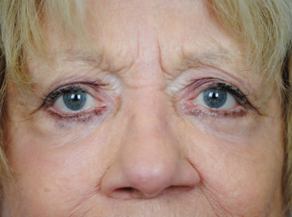 Lowcountry Lid Lift Blepharoplasty Before and After | Thomas Funcik MD