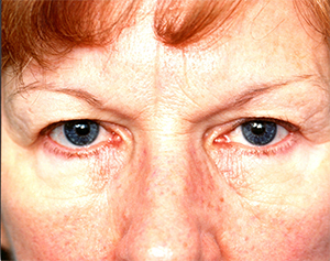 Lowcountry Lid Lift Blepharoplasty Before and After | Thomas Funcik MD