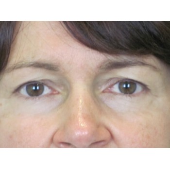 Lowcountry Lid Lift Blepharoplasty Before and After | Thomas Funcik MD