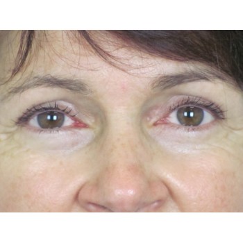 Lowcountry Lid Lift Blepharoplasty Before and After | Thomas Funcik MD