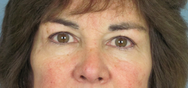 Lowcountry Lid Lift Blepharoplasty Before and After | Thomas Funcik MD