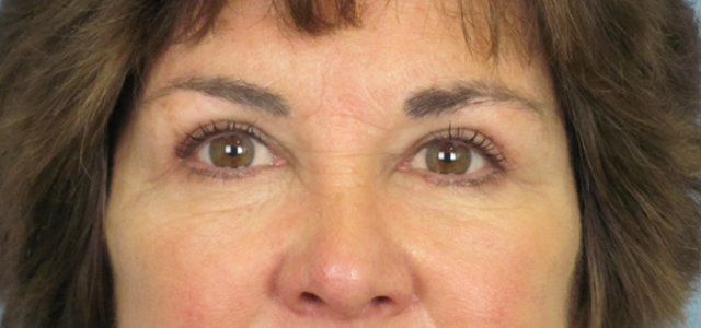 Lowcountry Lid Lift Blepharoplasty Before and After | Thomas Funcik MD