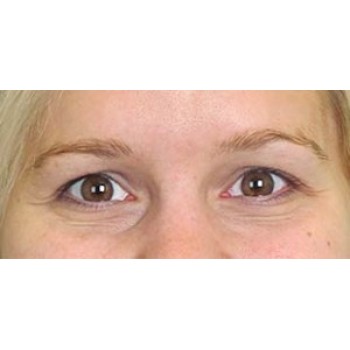 Lowcountry Lid Lift Blepharoplasty Before and After | Thomas Funcik MD