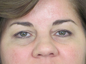 Lowcountry Lid Lift Blepharoplasty Before and After | Thomas Funcik MD