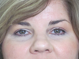 Lowcountry Lid Lift Blepharoplasty Before and After | Thomas Funcik MD