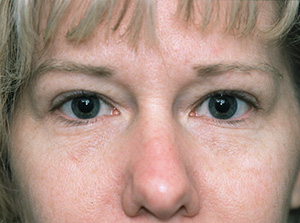 Lowcountry Lid Lift Blepharoplasty Before and After | Thomas Funcik MD