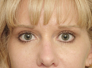 Lowcountry Lid Lift Blepharoplasty Before and After | Thomas Funcik MD