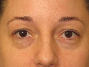 Lowcountry Lid Lift Blepharoplasty Before and After | Thomas Funcik MD