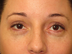 Lowcountry Lid Lift Blepharoplasty Before and After | Thomas Funcik MD