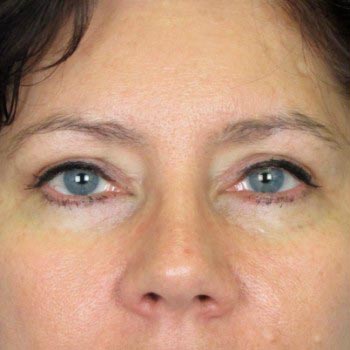 Lowcountry Lid Lift Blepharoplasty Before and After | Thomas Funcik MD