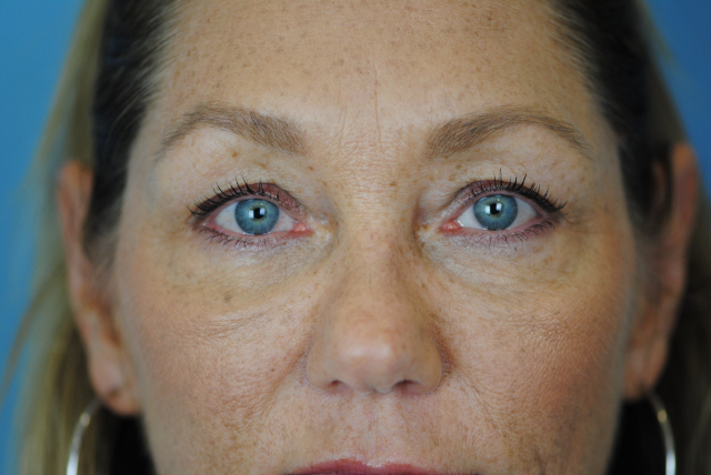 Lowcountry Lid Lift Blepharoplasty Before and After | Thomas Funcik MD