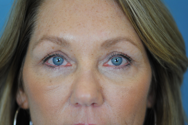 Lowcountry Lid Lift Blepharoplasty Before and After | Thomas Funcik MD