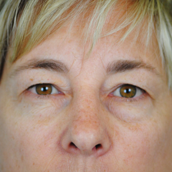 Lowcountry Lid Lift Blepharoplasty Before and After | Thomas Funcik MD