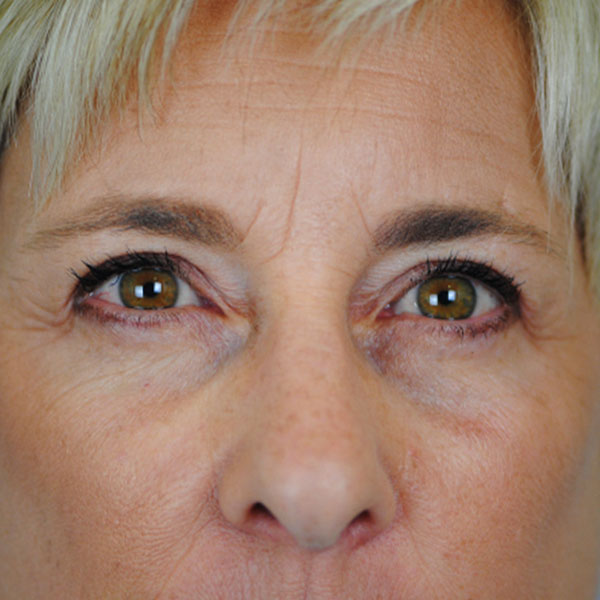 Lowcountry Lid Lift Blepharoplasty Before and After | Thomas Funcik MD