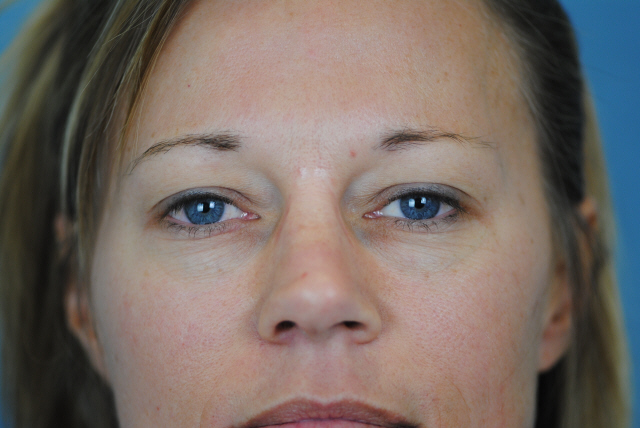 Lowcountry Lid Lift Blepharoplasty Before and After | Thomas Funcik MD