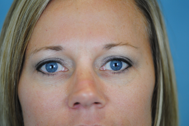 Lowcountry Lid Lift Blepharoplasty Before and After | Thomas Funcik MD