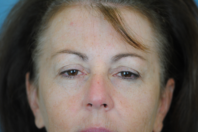 Lowcountry Lid Lift Blepharoplasty Before and After | Thomas Funcik MD