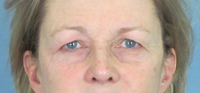 Lowcountry Lid Lift Blepharoplasty Before and After | Thomas Funcik MD