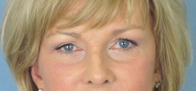 Lowcountry Lid Lift Blepharoplasty Before and After | Thomas Funcik MD