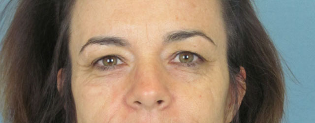 Lowcountry Lid Lift Blepharoplasty Before and After | Thomas Funcik MD