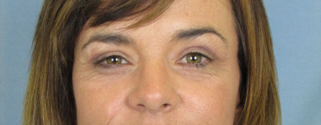 Lowcountry Lid Lift Blepharoplasty Before and After | Thomas Funcik MD