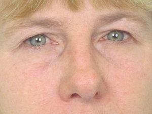 Lowcountry Lid Lift Blepharoplasty Before and After | Thomas Funcik MD