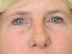 Lowcountry Lid Lift Blepharoplasty Before and After | Thomas Funcik MD