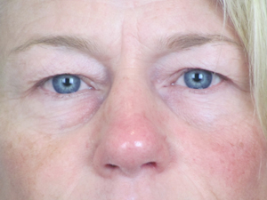 Lowcountry Lid Lift Blepharoplasty Before and After | Thomas Funcik MD