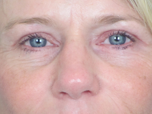 Lowcountry Lid Lift Blepharoplasty Before and After | Thomas Funcik MD