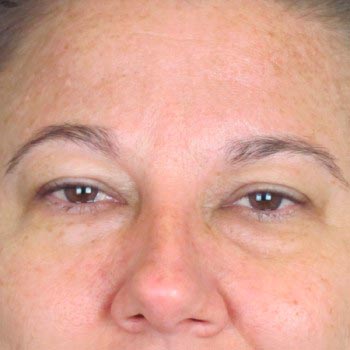 Lowcountry Lid Lift Blepharoplasty Before and After | Thomas Funcik MD