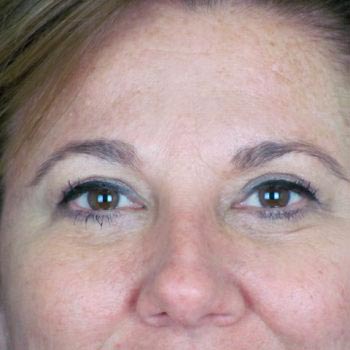 Lowcountry Lid Lift Blepharoplasty Before and After | Thomas Funcik MD