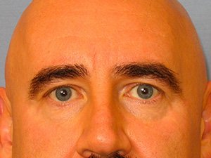 Lowcountry Lid Lift Blepharoplasty Before and After | Thomas Funcik MD