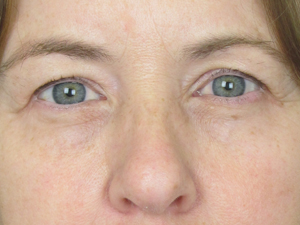 Lowcountry Lid Lift Blepharoplasty Before and After | Thomas Funcik MD