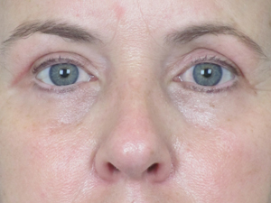 Lowcountry Lid Lift Blepharoplasty Before and After | Thomas Funcik MD