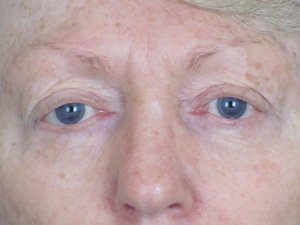 Lowcountry Lid Lift Blepharoplasty Before and After | Thomas Funcik MD