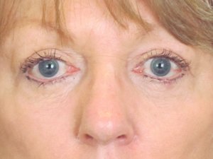 Lowcountry Lid Lift Blepharoplasty Before and After | Thomas Funcik MD