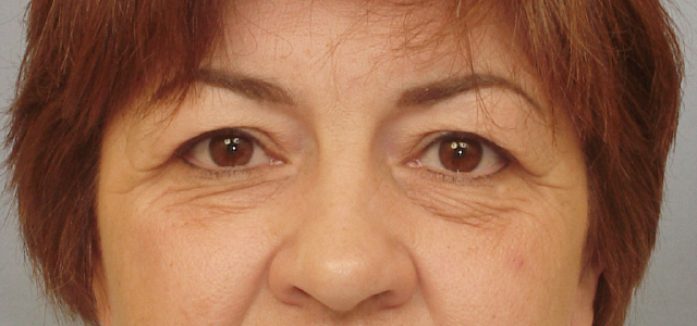 Lowcountry Lid Lift Blepharoplasty Before and After | Thomas Funcik MD