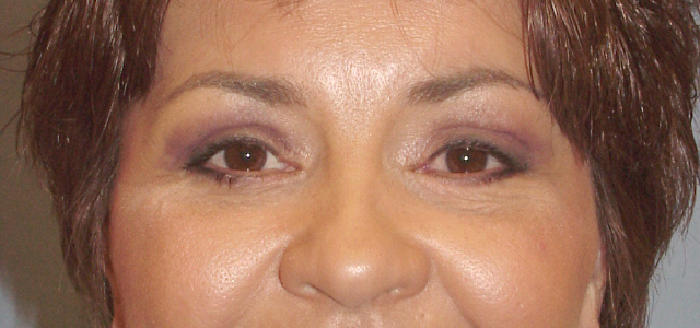 Lowcountry Lid Lift Blepharoplasty Before and After | Thomas Funcik MD