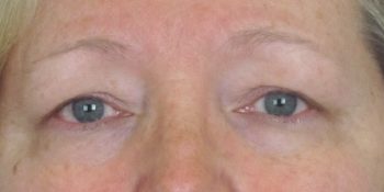 Lowcountry Lid Lift Blepharoplasty Before and After | Thomas Funcik MD