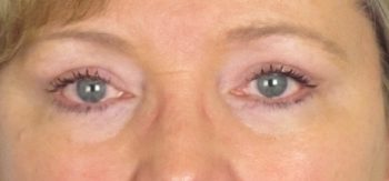 Lowcountry Lid Lift Blepharoplasty Before and After | Thomas Funcik MD