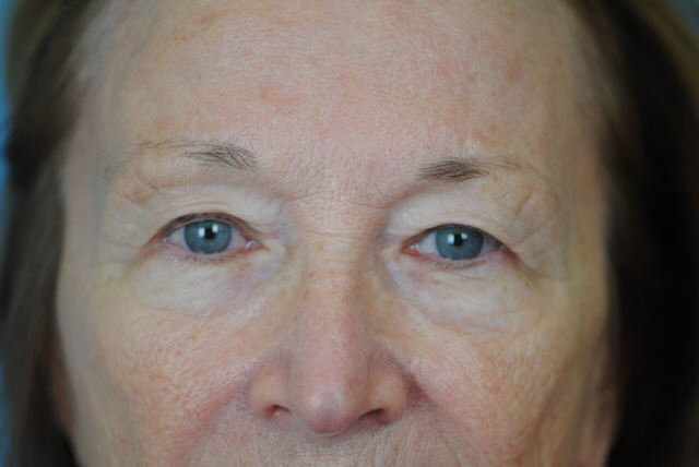 Lowcountry Lid Lift Blepharoplasty Before and After | Thomas Funcik MD