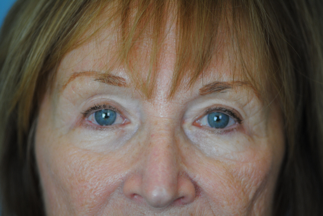 Lowcountry Lid Lift Blepharoplasty Before and After | Thomas Funcik MD