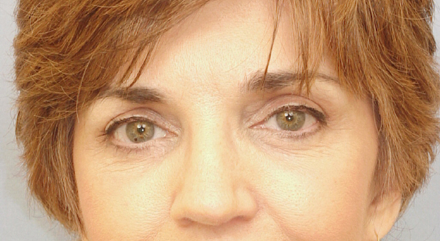 Lowcountry Lid Lift Blepharoplasty Before and After | Thomas Funcik MD