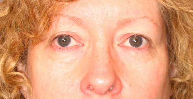 Lowcountry Lid Lift Blepharoplasty Before and After | Thomas Funcik MD