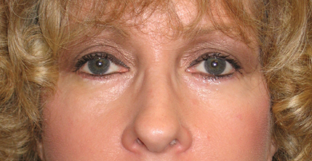 Lowcountry Lid Lift Blepharoplasty Before and After | Thomas Funcik MD